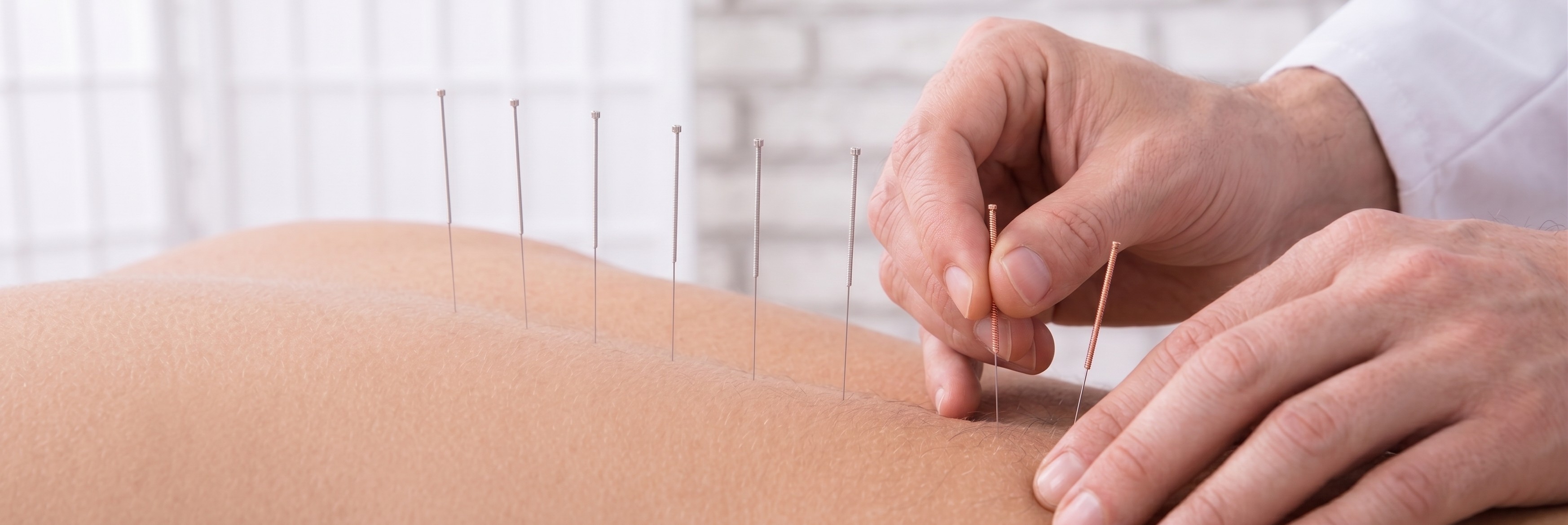 Medical Acupuncture